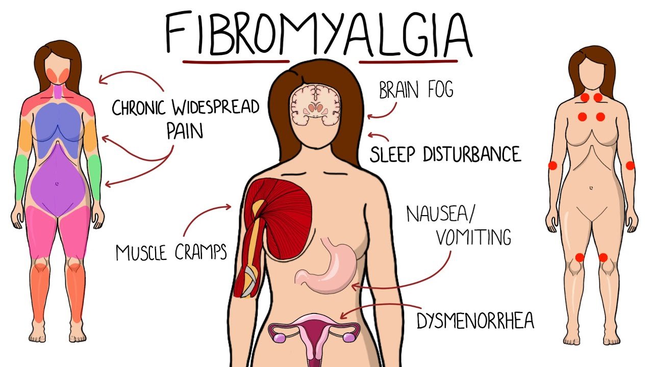 6 symptômes indolores de la fibromyalgie qui passent souvent inaperçus
